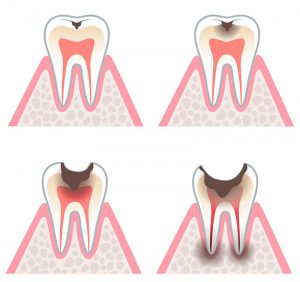 Root canal Therapy