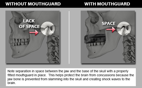 Concussion prevention