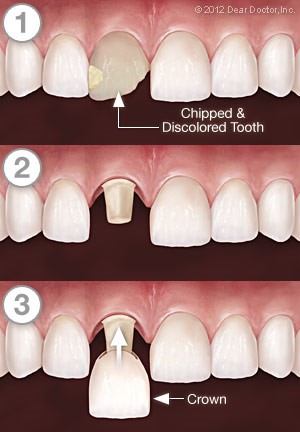 Crowning or Capping a Tooth